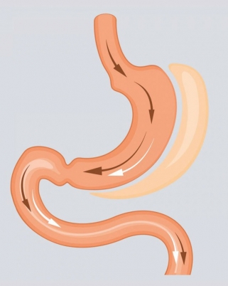 Kurus Sebab Bariatric Surgery? ‘Rahsia’ Kurus Dalam Masa Sebulan!
