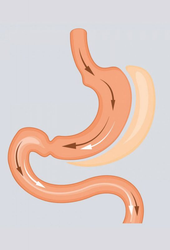 Kurus Sebab Bariatric Surgery? ‘Rahsia’ Kurus Dalam Masa Sebulan!