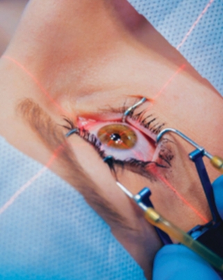 Pembedahan LASIK: Segalanya Yang Perlu Kamu Tahu Tentangnya