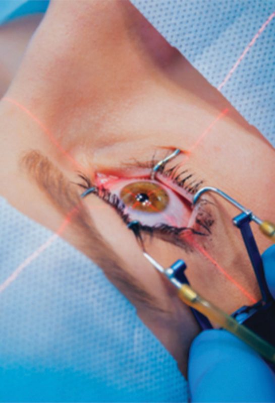 Pembedahan LASIK: Segalanya Yang Perlu Kamu Tahu Tentangnya