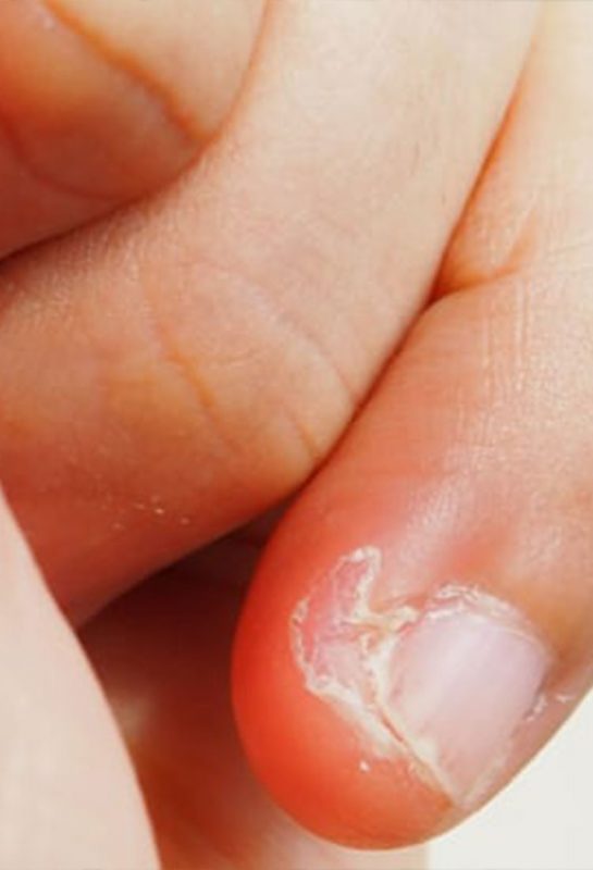 Kulit Jari Mengelupas: Jom Bongkar 9 Sebab Misteri