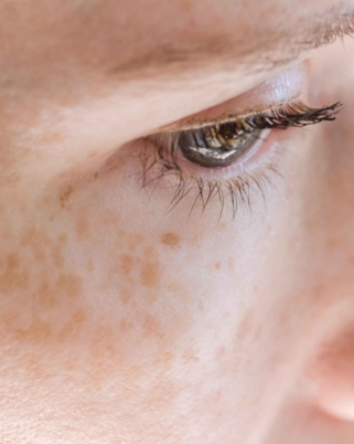 Masalah Pigmentasi Kulit: Apa Yang Saya Pelajari Dari Dr Che Hafiz di Regalion Clinic