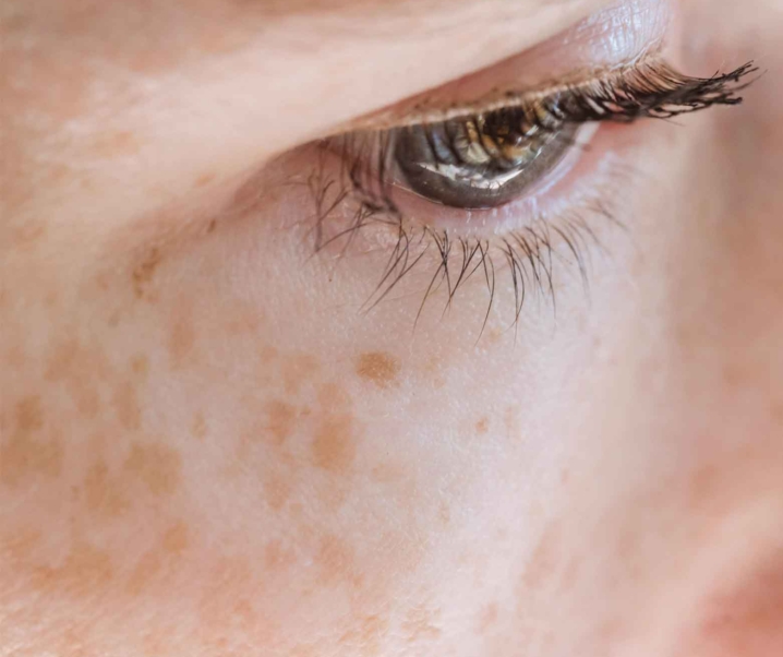 Masalah Pigmentasi Kulit: Apa Yang Saya Pelajari Dari Dr Che Hafiz di Regalion Clinic